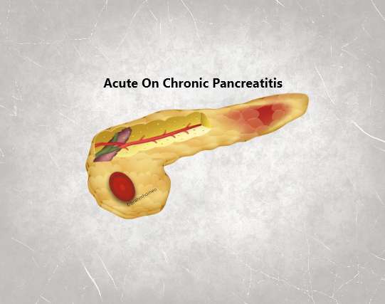 Acute On Chronic Pancreatitis