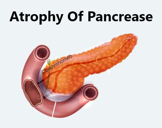 Atrophy of pancreas treatment
