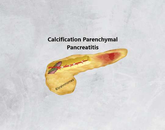 Calcification  Of Pancrease