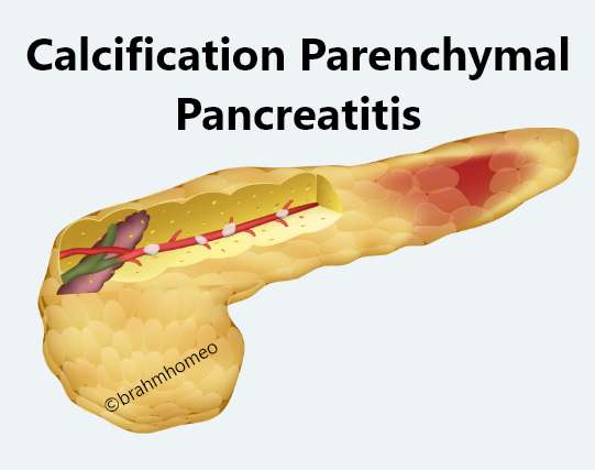 Calcification Parenchymal Pancreatitis