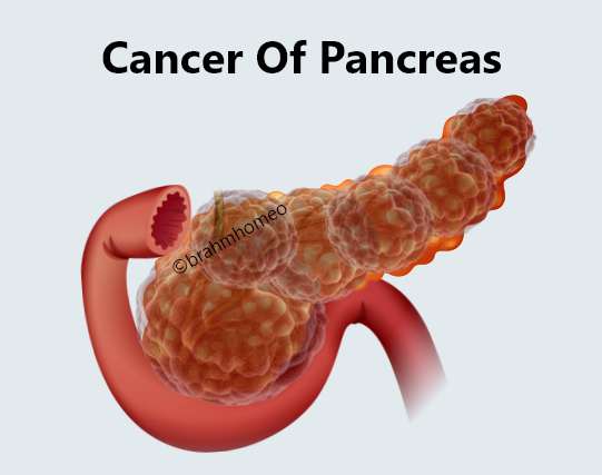 Cancer of pancreas treatment 