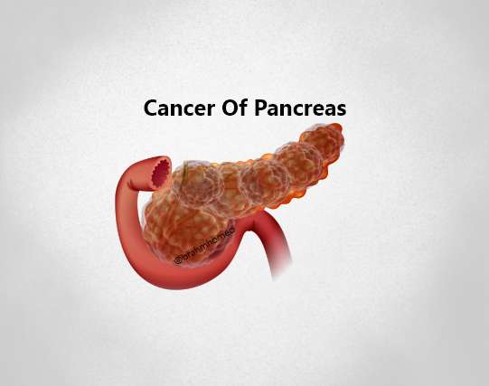 Cancer Of Pancrease