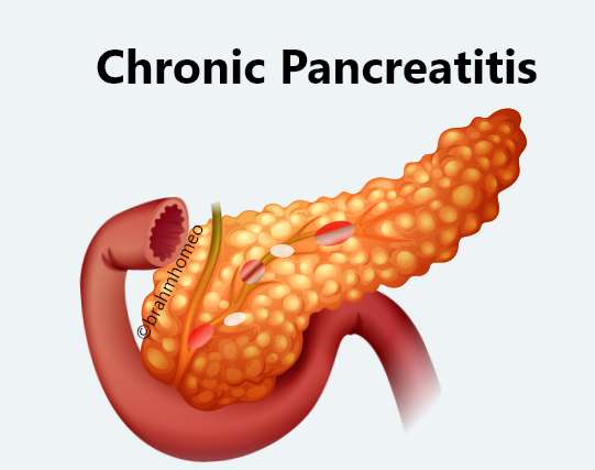 Chronic pancreatitis treatment