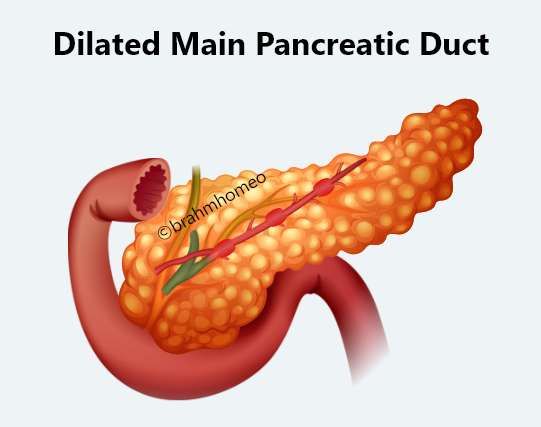 Dilated Main Pancreatic Duct treatment