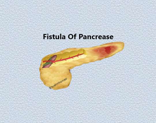 Aneurism OF Arteries Of Pancrease