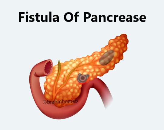 fistula of pancreas