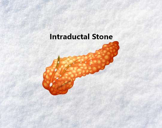 Intraductal Calcification  Stone