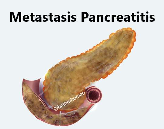 metastasisi pancreatitis
