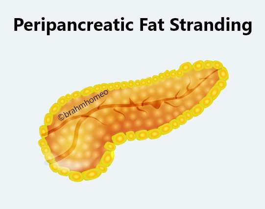 peripancreatic fat stranding