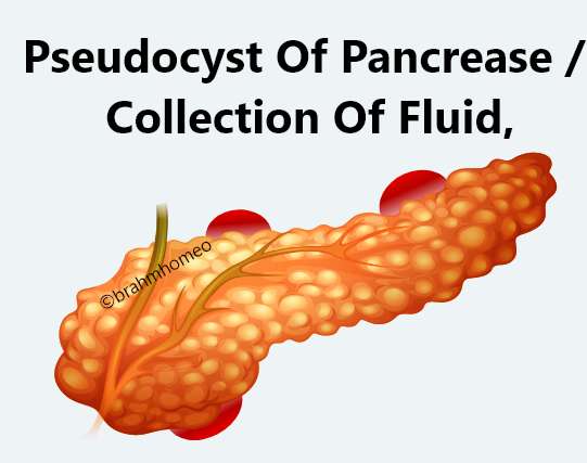 Pseudocyst Of Pancreas Collection Of Fluid 
